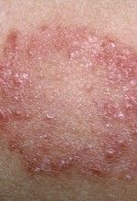 Ringworm