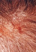 itchy scalp itchy scalp