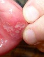Mouth Ulcer Treatment