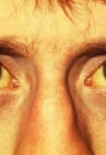jaundice