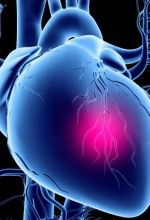 myocardial infarction causes and symptoms myocardial infarction causes and symptoms