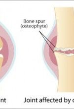 Arthritis