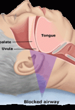 sleep apnea