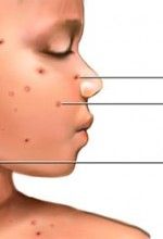 Chickenpox scars