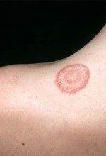 Fungal infections