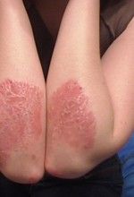 symptoms of psoriasis