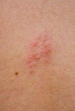 Symptoms of shingles