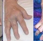 Hands affected by rheumatoid arthritis