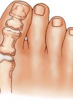 bunion causes symptoms and treatment