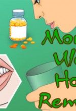 Mouth blisters remedies