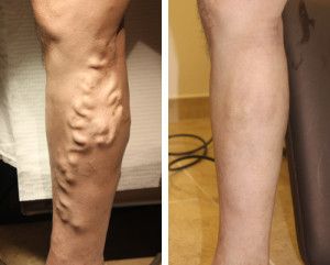 An Before and After Analysis